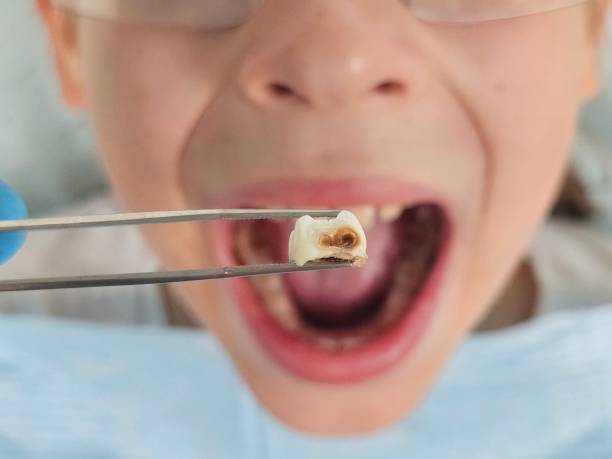 Best Walk-In Emergency Dentist in Port Barre, LA